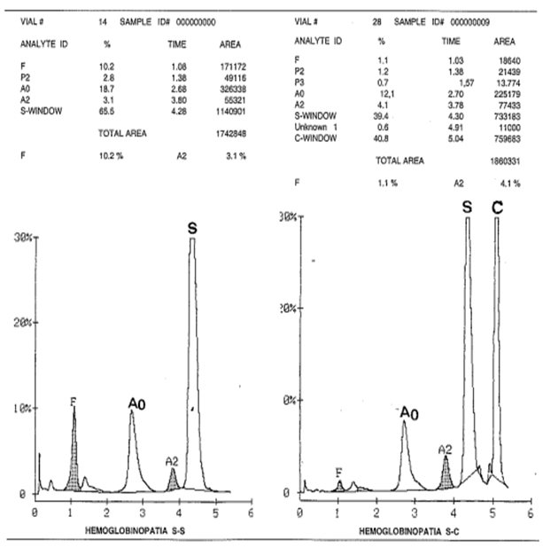 Figura
1. Cromatogramas con resultados de hemoglobina variante